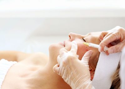 Vampir Lifting Therapie durch Facharzt